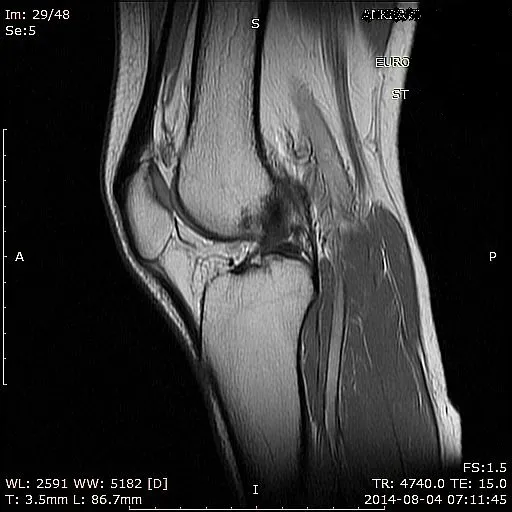 mri